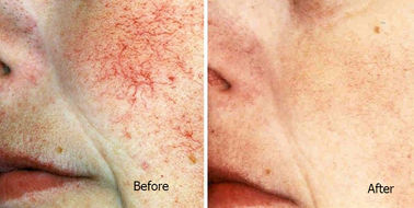 Frekuensi tinggi Vascular Leg Spider Vein Penghapusan Mesin Untuk Spider Darah izin